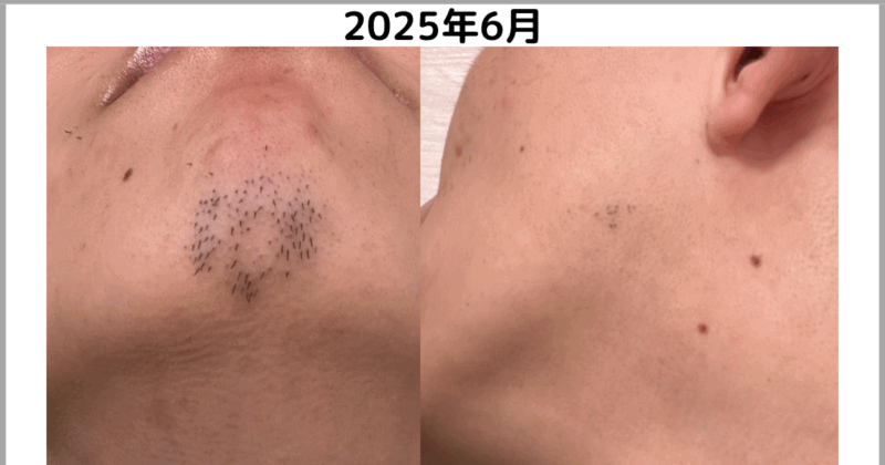 2025年6月髭まわりr1